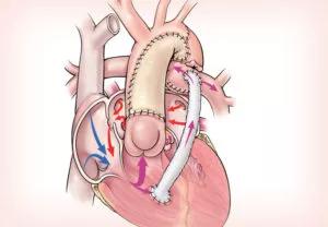 detailed anatomy of the heart defect 