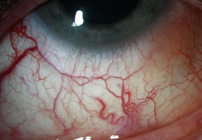Ocular Adnexal Lymphoma Masquerading as Glaucoma