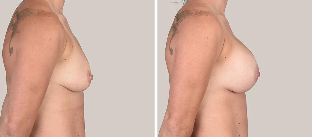 Breast augmentation before & after photo