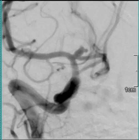 aneurysm of right anterior cerebral artery on angiography