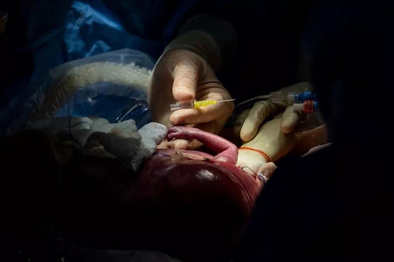 With the fetus’s arm exteriorized, Dr. Cass uses a needle to start an IV line.