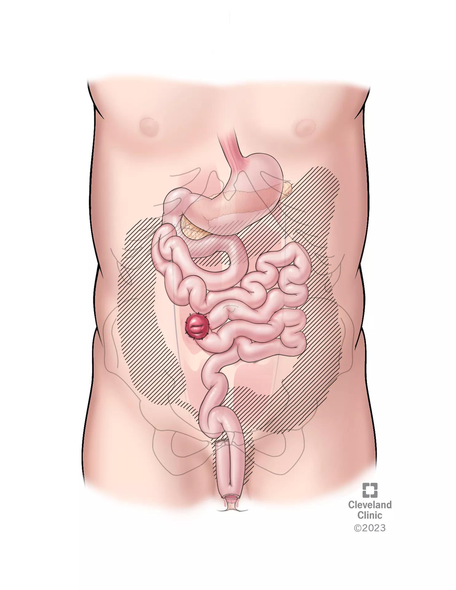【ボクくん様用】ULCER / Grant Us Death UC Patients with PG Have Worse Outcomes with J-Pouch Surgery