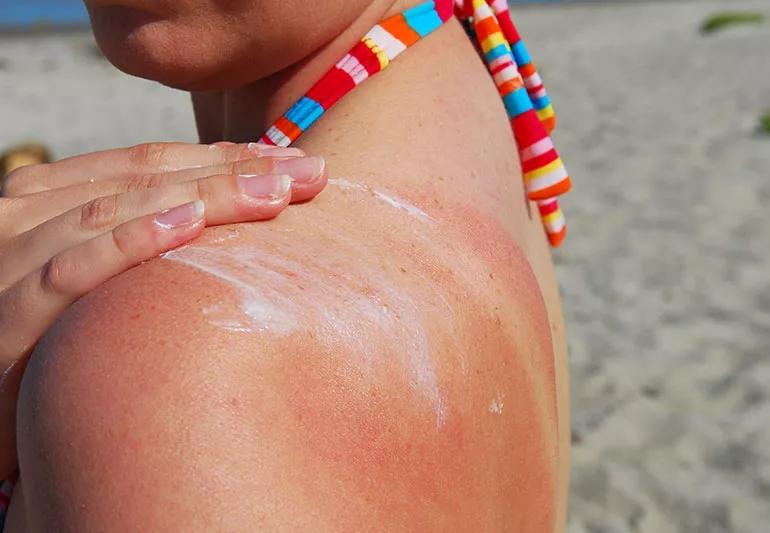 How to tan safely: 9 tips to minimize the risks