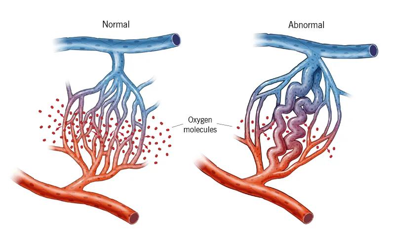 Normal and abnormal capillary beds