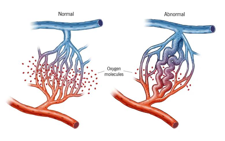 Normal and abnormal capillary beds