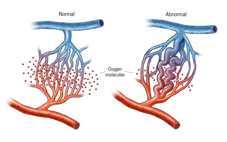 Normal and abnormal capillary beds