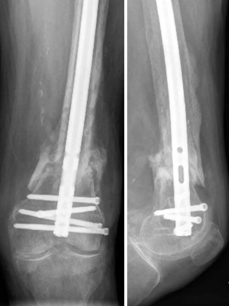 X-rays after surgery