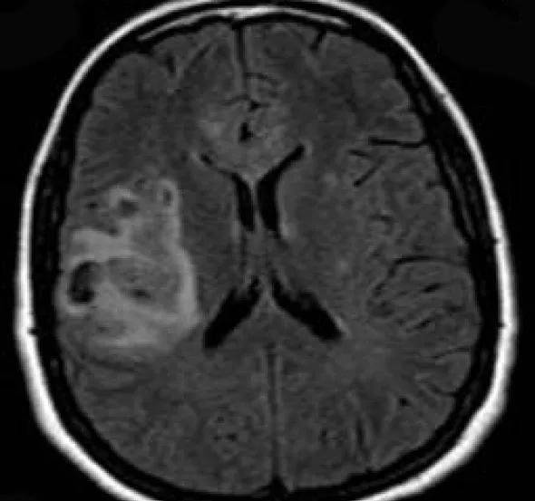 Figure 2. Brain CT at presentation shows a hyperintensity in the subcortical white matter underlying the right supramarginal gyrus with separate patchy hyperintensity in the overlying right frontoparietal lobe. Abnormal hyperintensity is present along the cortex of the right parietal operculum and supramarginal gyrus. No significant mass effect is present.