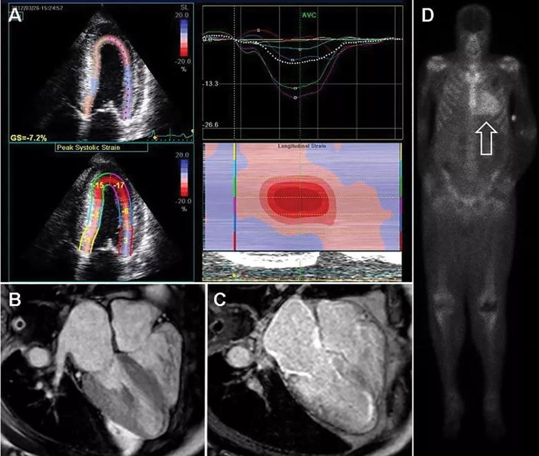 Noninvasive imaging for cardiac amyloidosis. 