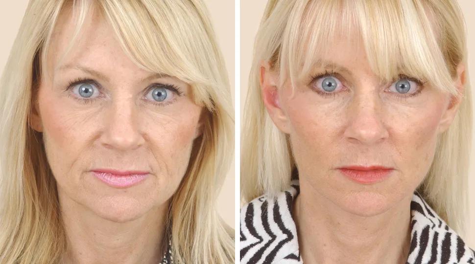 Facelift before & after photo