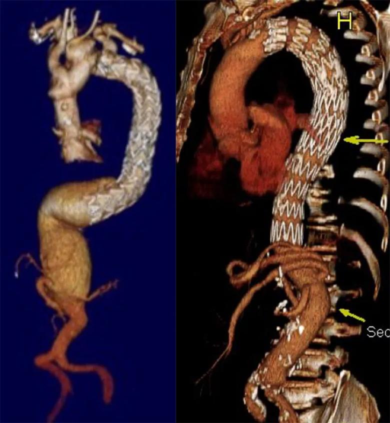 3D CTs showing ultra-hybrid repair of thoracoabdominal aortic aneurysm