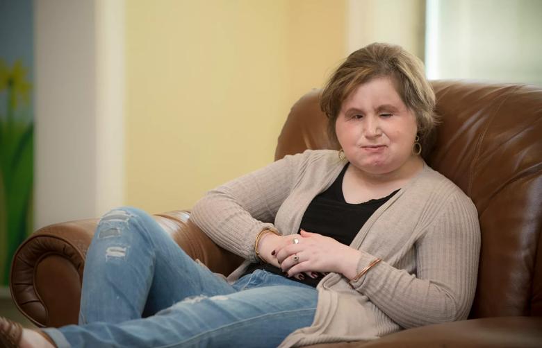 Katie Stubblefield face transplant Cleveland Clinic