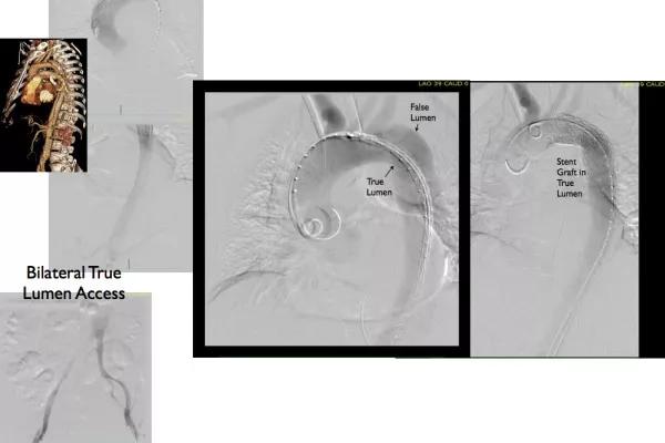 Figure 4. Deployment of the thoracic stent graft.