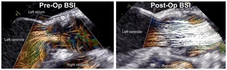 Blood speckle imaging of the aortic valvar leaflets 