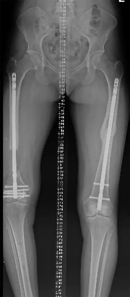 X-ray showing right femur with 8 cm bone void