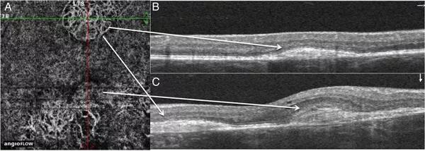 Optical coherence tomography and OCT angiography images of a patient with multiple choroidal neovascularisation are shown.