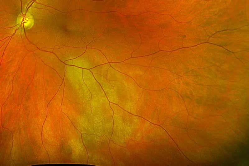 Metastatic cancer in the macula