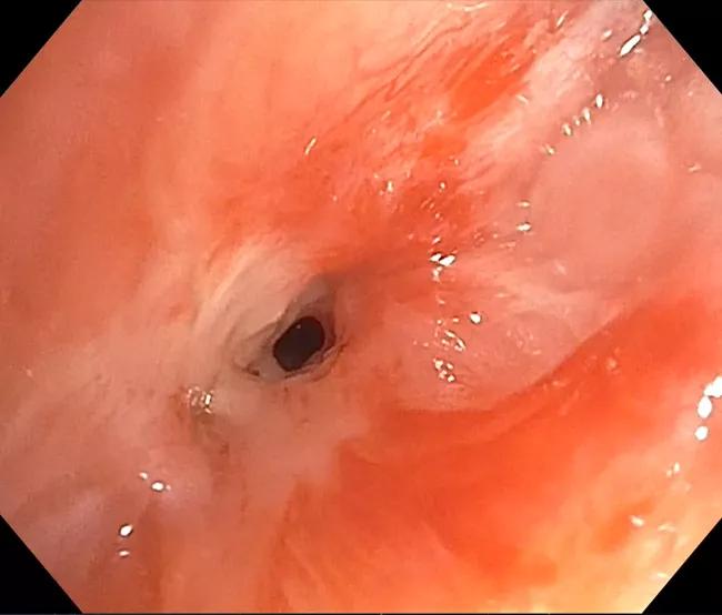 Airway