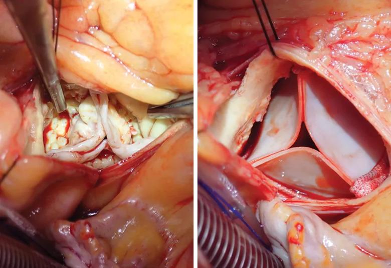 operative photos of aortic valve replacement