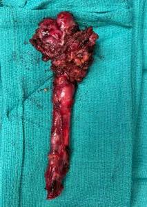 complete resection image