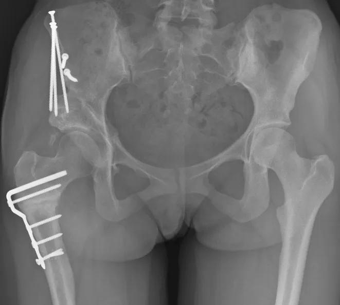 X-ray of pelvis showing bright white pins
