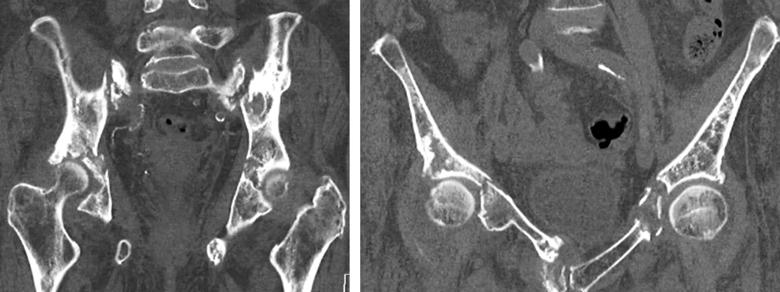 CT images of pelvic fractures