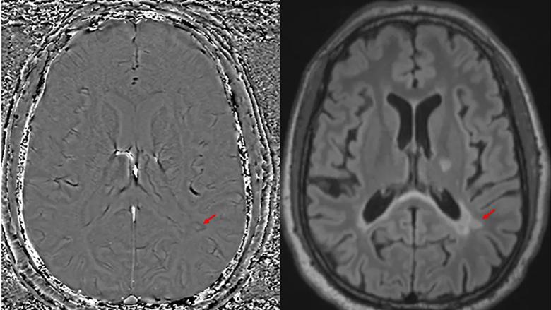two brain MRIs with red arrows indicating spots of interest