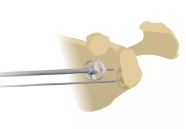 Surface preparation of the anterior glenoid face