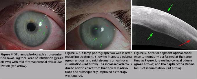 CQD2setContactLense