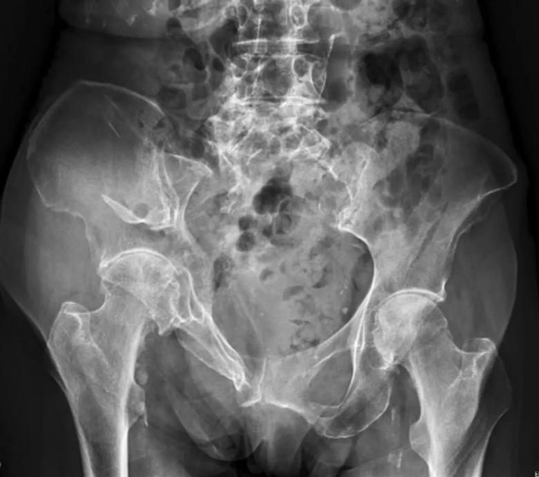 X-ray of pelvic fracture