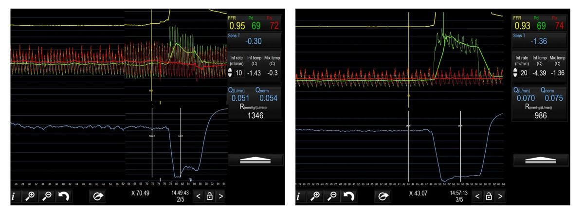 coronary microvascular function testing