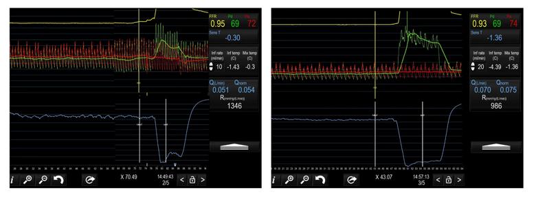 coronary microvascular function testing