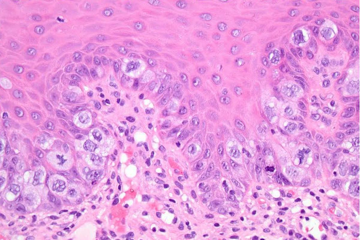 Paget cells micrograph