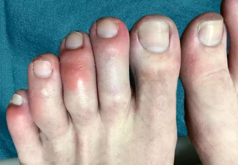 What are COVID Toes?