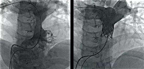 Angiograms before (top) and after (bottom) placement of a Melody Transcatheter Pulmonary Valve.