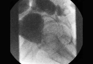 Negative postoperative barium enema