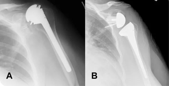 Figure 3 A: Plain radiograph shows rotator cuff deficiency and superior migration of the humeral prosthesis after standard total shoulder replacement elsewhere. B: Postoperative radiograph after revision to reverse total shoulder replacement at Cleveland Clinic. 