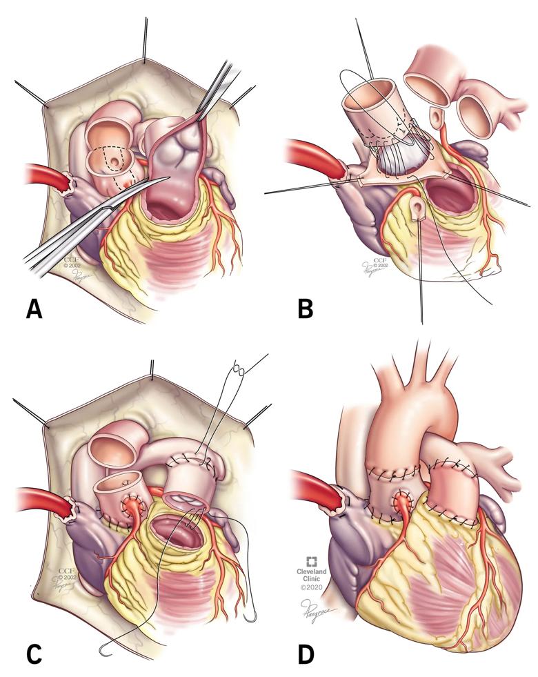 four-panel illustration of steps in a heart operation