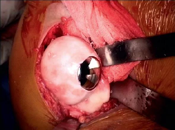 Figure 1. Intraoperative photograph of a partial cap resurfacing implant used for treatment of a Hill-Sachs lesion. 