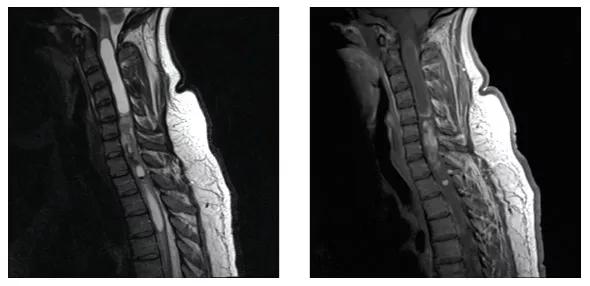 benzel-tumor-fig1