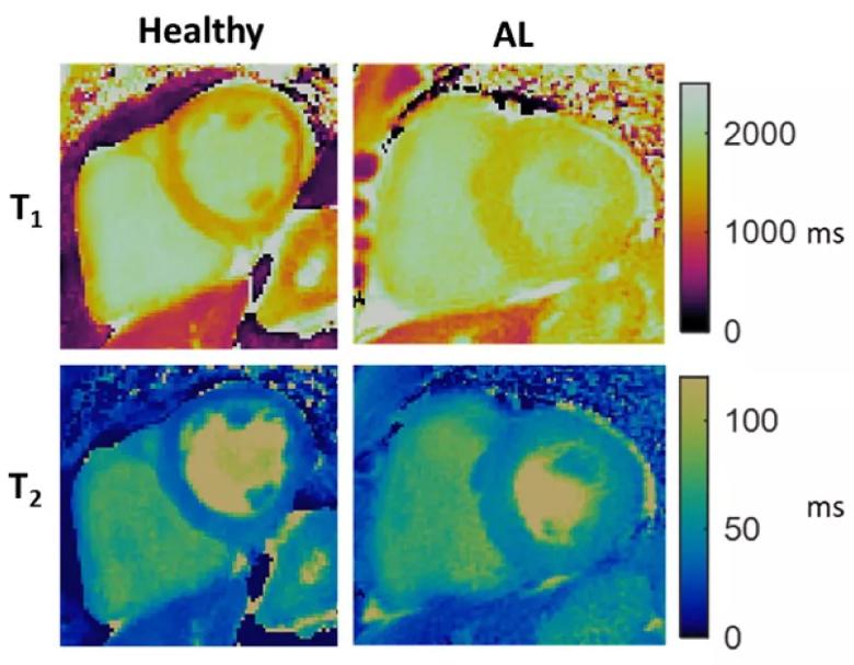 cardiac magnetic resonance fingerprinting image