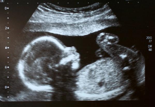 Fetus ultrasound