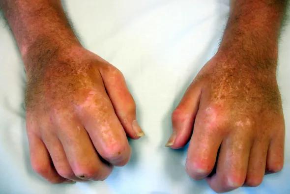 Figure 2. Diffuse swelling and induration of skin in a patient with early diffuse scleroderma.