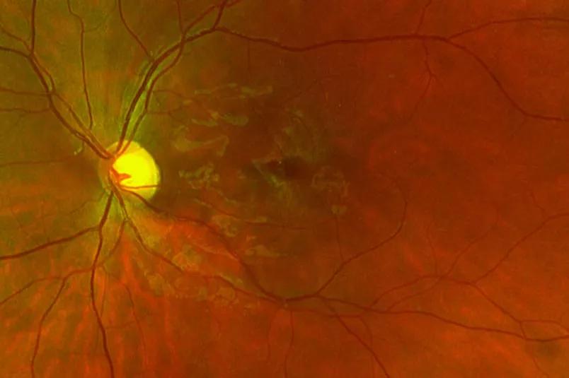 Fundus photo of healthy macula