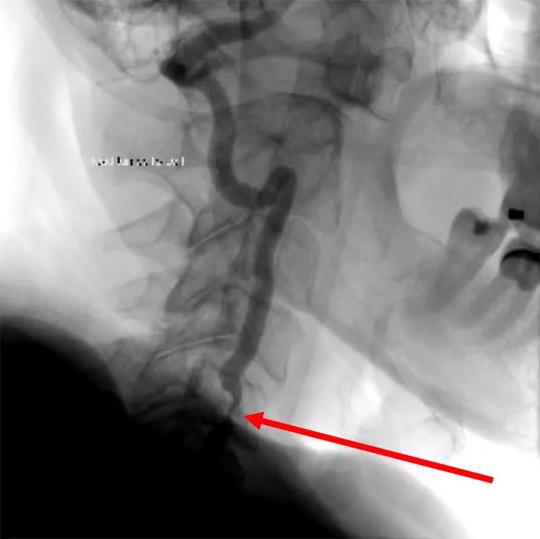 severe vertebral artery stenosis in a patient with bow hunter's syndrome