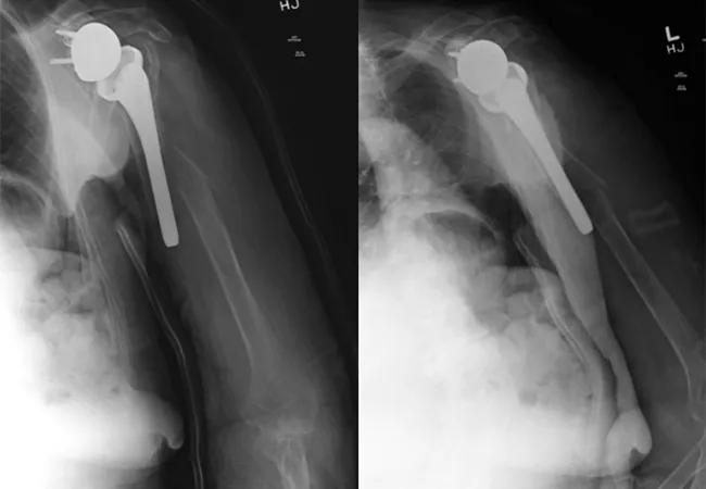 Fracture