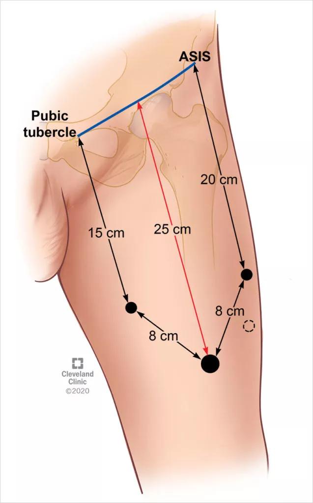 A closer look of the inguinal lymph node dissection.