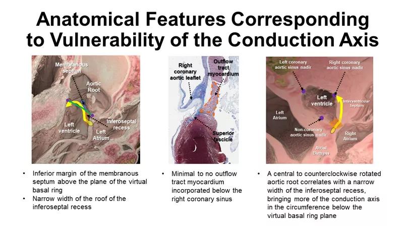 Image highlights anatomical features of aortic root 