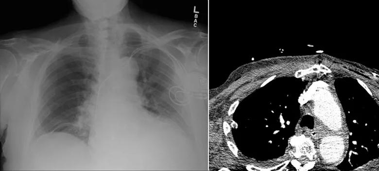 Figure 2. Although a preoperative chest radiograph (left) showed no evidence of an enlarged mediastinal or cardiac shadow to suggest an aortic aneurysm or a pericardial effusion, a postoperative CT (right) showed a generous aorta, suggesting that the patient was predisposed to aortic dissection or rupture.