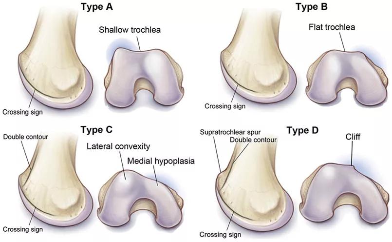 Illustration of various types of knee joints